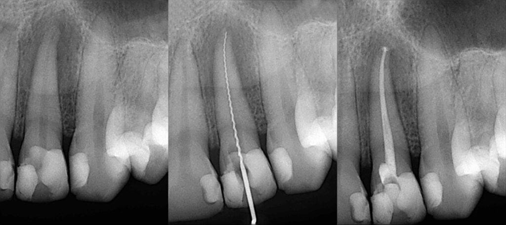 Root Canal Treatment - X-Ray