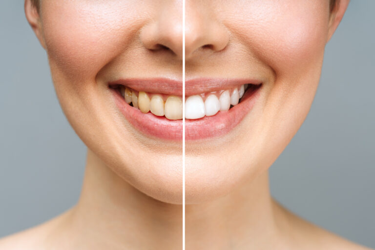 before and after whitening