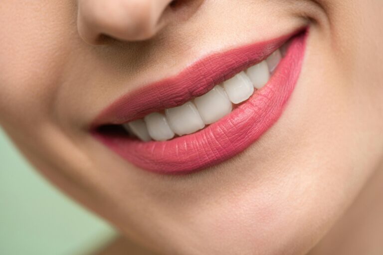 composite-bonding-sandgate-dentist