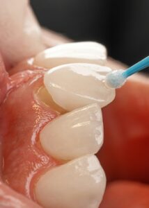 Veneer being placed on tooth